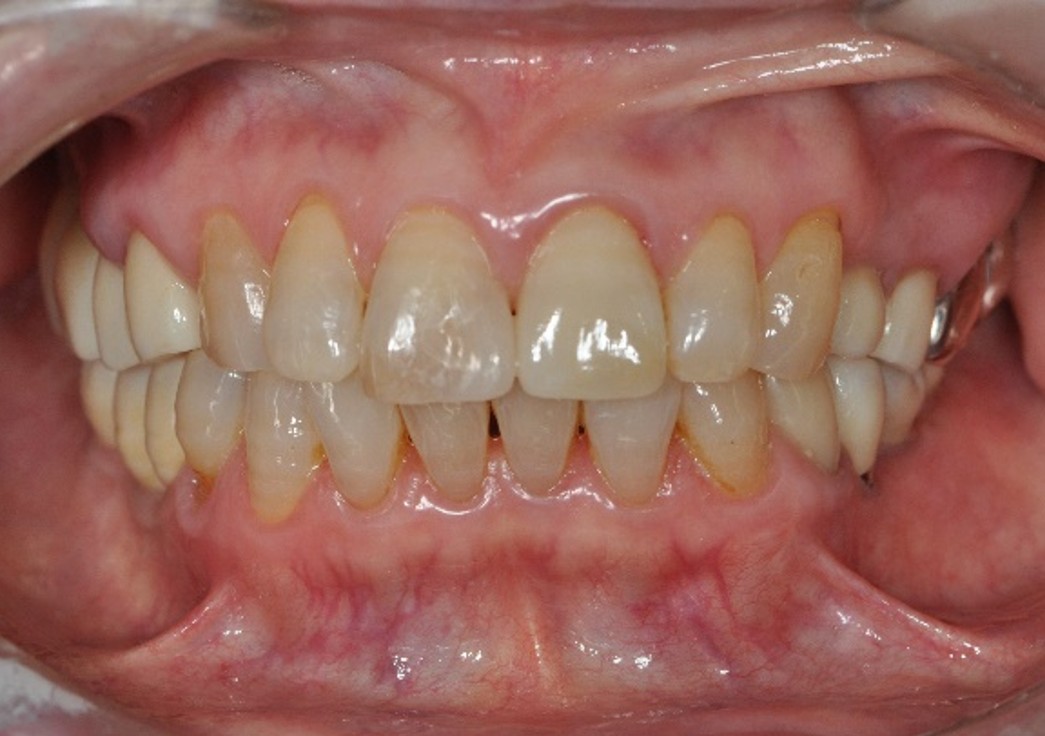 インプラント症例2