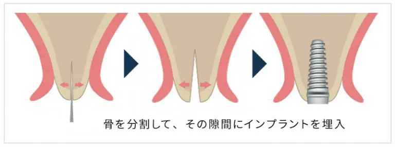 スプリットクレスト（歯槽堤分割術）