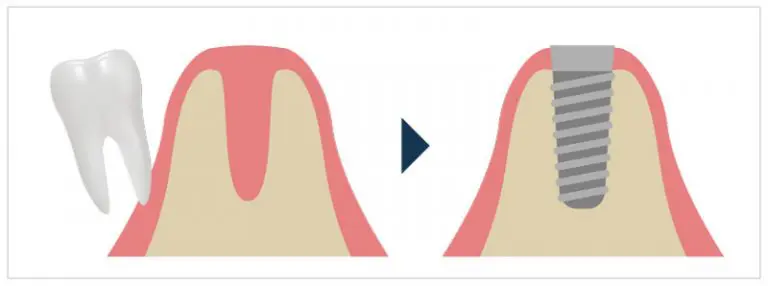 抜歯即時インプラント
