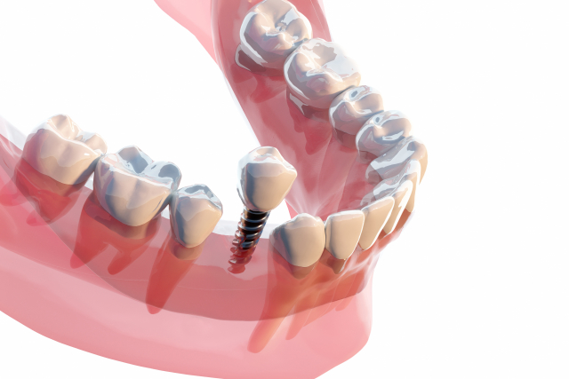 インプラントについて