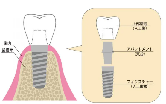 インプラントの構造