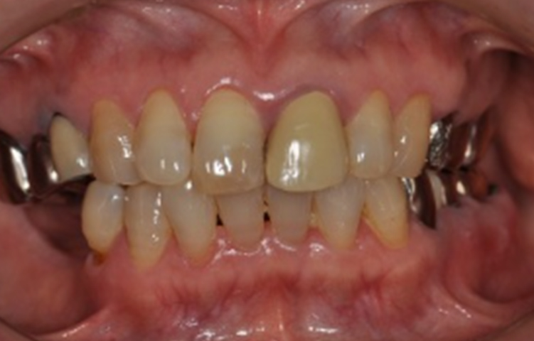 審美性も妥協しない技工所を併設 天然歯に近い仕上がり