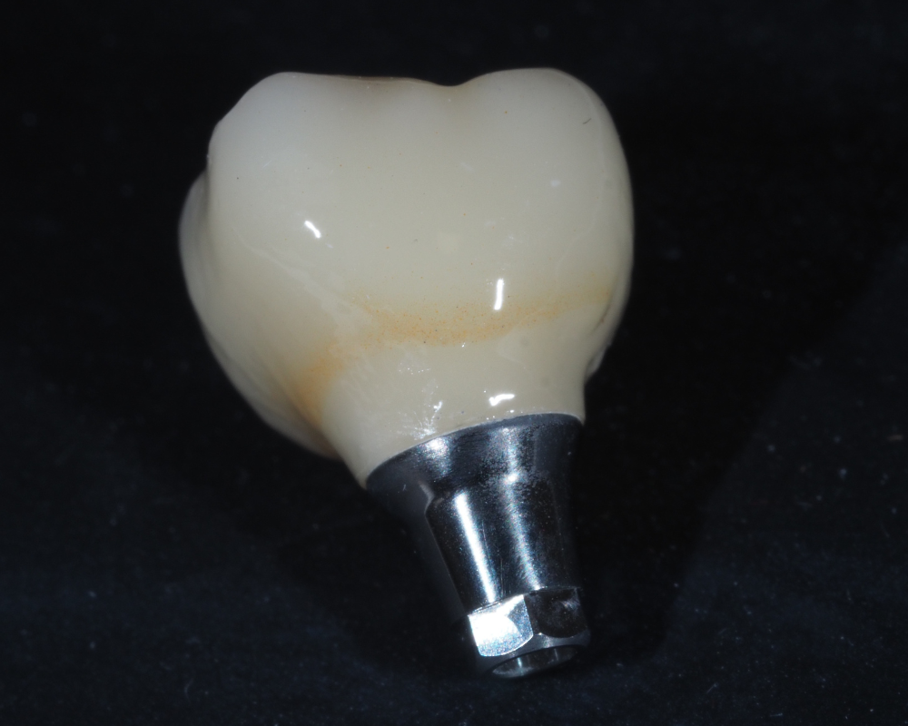 院内技工による高品質な被せ物