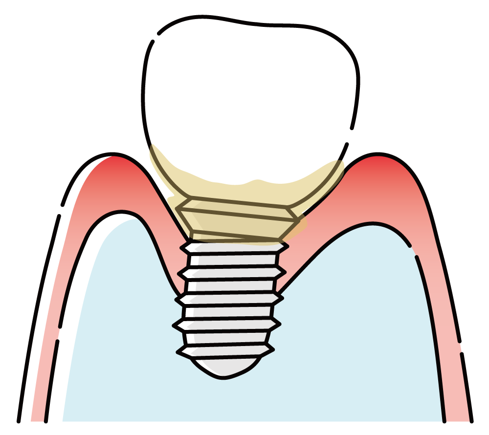 インプラント周囲炎