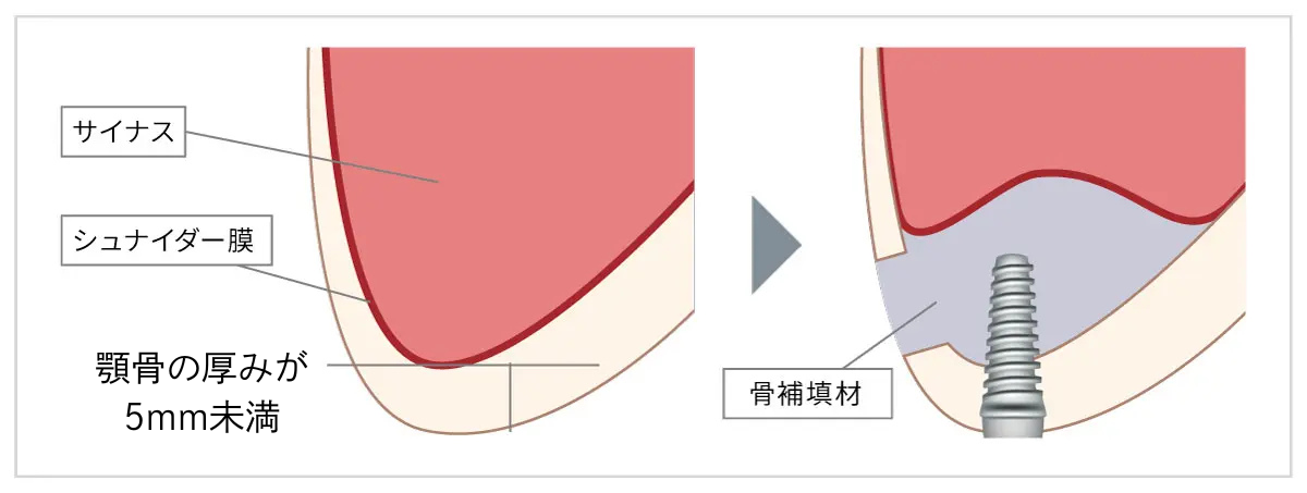 サイナスリフト（上顎洞底挙上術）
