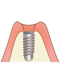 インプラント体の埋入