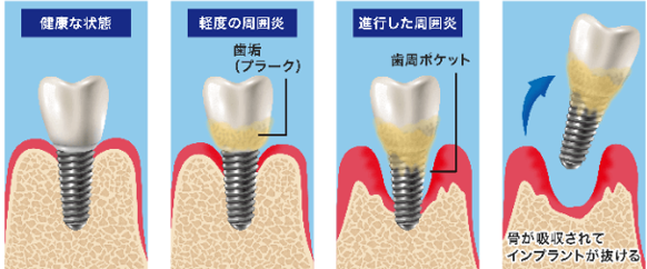 インプラント周囲炎