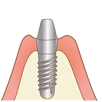 アバットメント（土台）装着